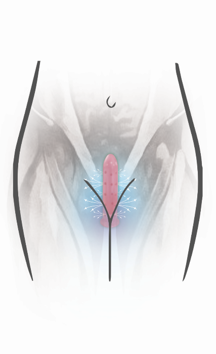 Size 6 Neodymium Magnetic  Vuvatech    Vaginal Dilators